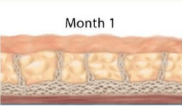 Ultherapy first month