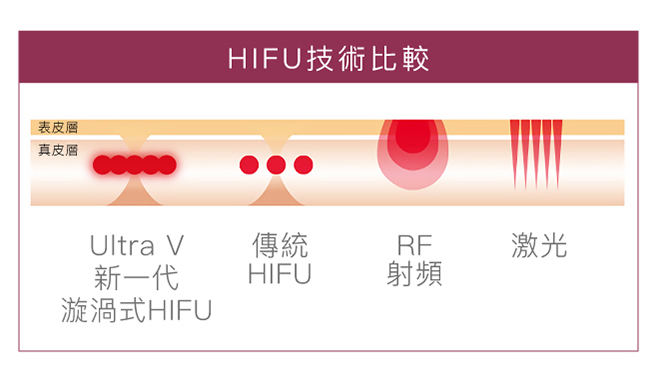 UltraV HIFU技術比較