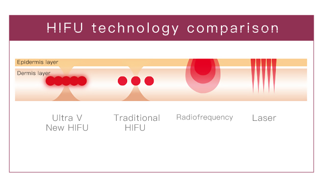 UltraV HIFU Technology Comparison